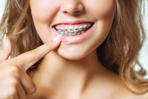 aparat ortodontyczny a leczenie zębów u dentysty